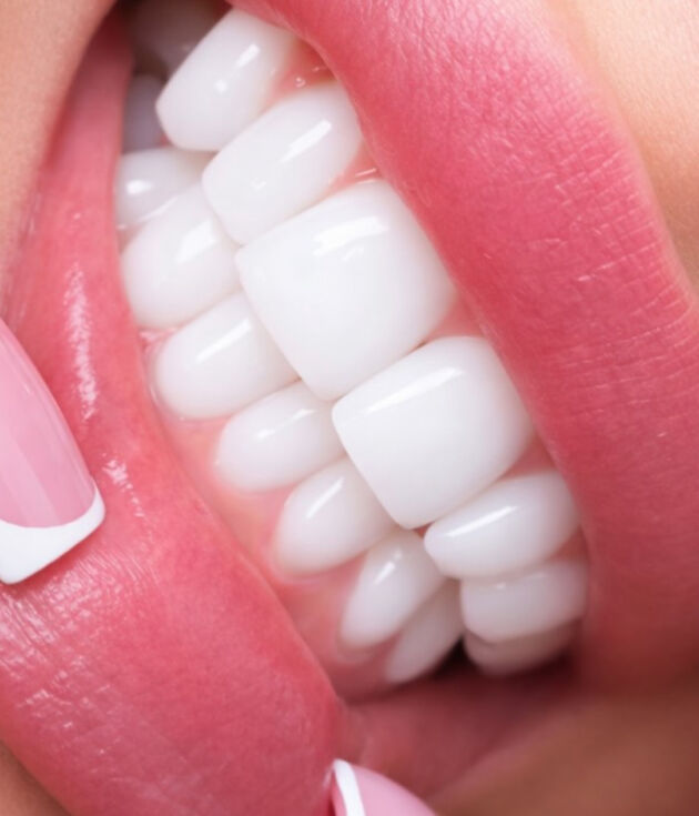 Blanchiment dentaire